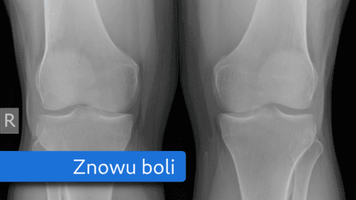 Kronika problemów z kolanami